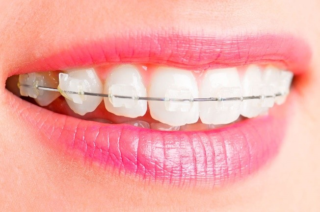 Policlínico Dental Dentus - Brackets Cerámicos