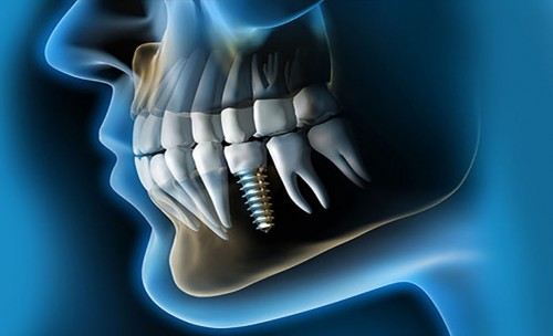 ¿Qué son los Implantes Dentales?