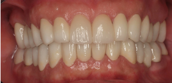Rehabilitación estética con coronas libres de metal para un problema severo de tinciones con tetraciclinas y mordida abierta