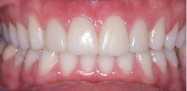 Blanqueamiento dental y carillas de porcelana para mejorar estética dental