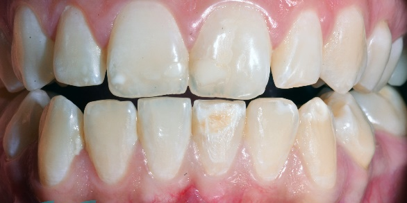 Pieza incisivo lateral izquierdo con  defecto en la producción de esmalte