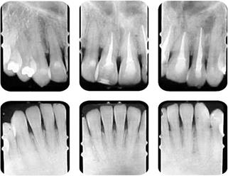Tratamiento de ortodoncia en el paciente adulto periodontalmente comprometido